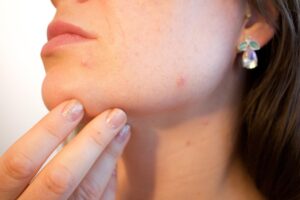Eczéma : comment traiter cette maladie de la peau ?
