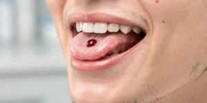 Boule de sang sous la langue : comment réagir face à ce symptôme buccal