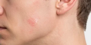 Derrière l’oreille qui suinte : la cause est-elle l’eczéma ou l’infection ?